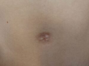 Umbilicus